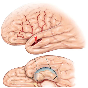 Epilepsy-neurological-disorder