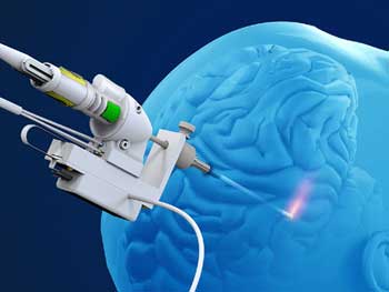 Laser Interstitial Thermal Therapy (LITT)