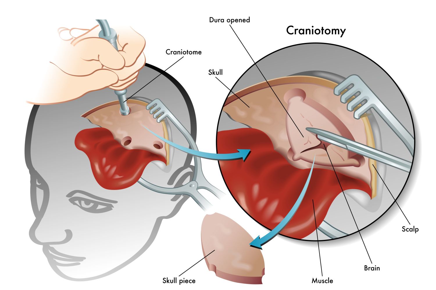  Brain Surgery