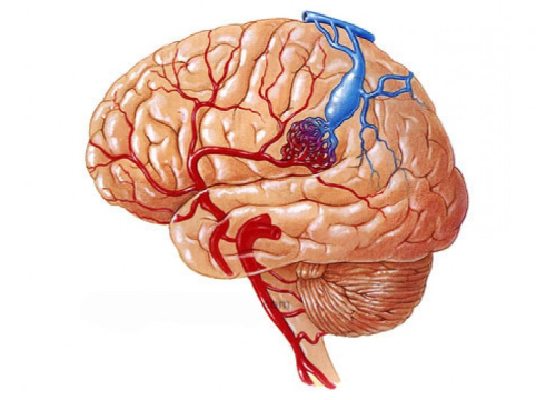 Arteriovenous Malformations (AVMs)