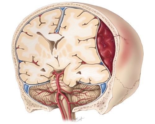 epidural-hematoma