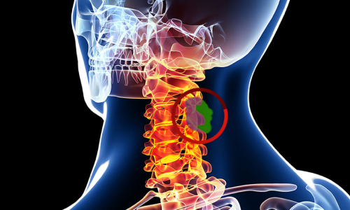 Spinal Cord Tumors