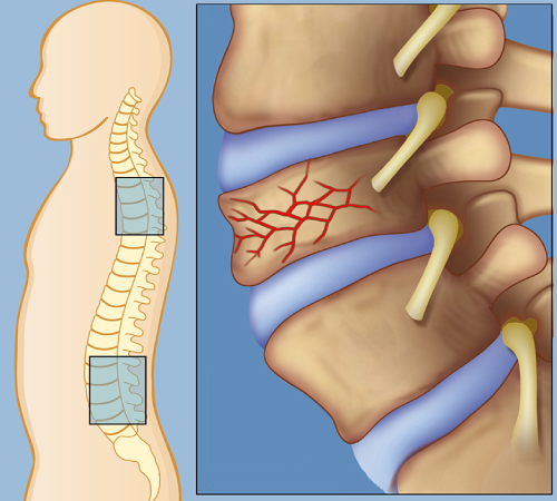 Arteriovenous Malformations (AVMs)