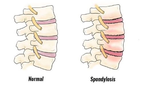 Spondylosis