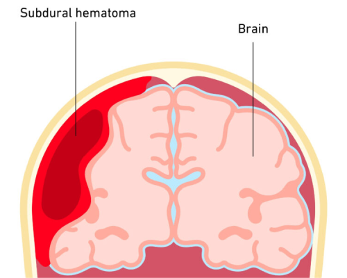 Arteriovenous Malformations (AVMs)