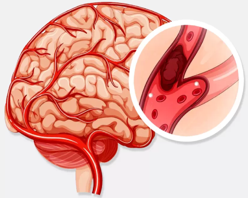 Surgical Solutions for AVMs