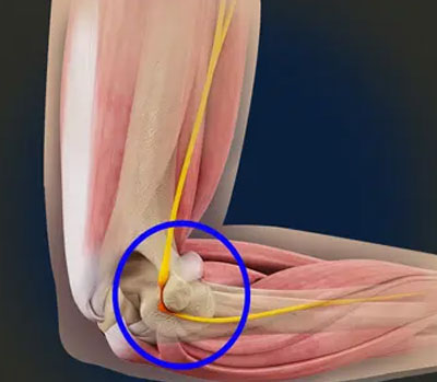 nerve-entrapment-surgery