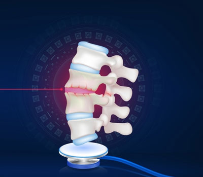 spondylosis