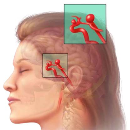 vascular-disease